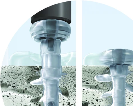 SpineWelding implants in bone