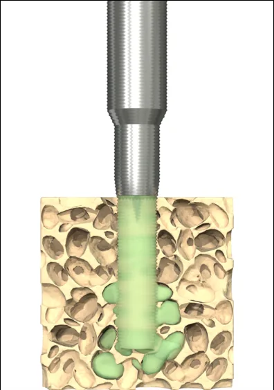 Step two: shear liquefies the polymer, which flows into the trabecular bone